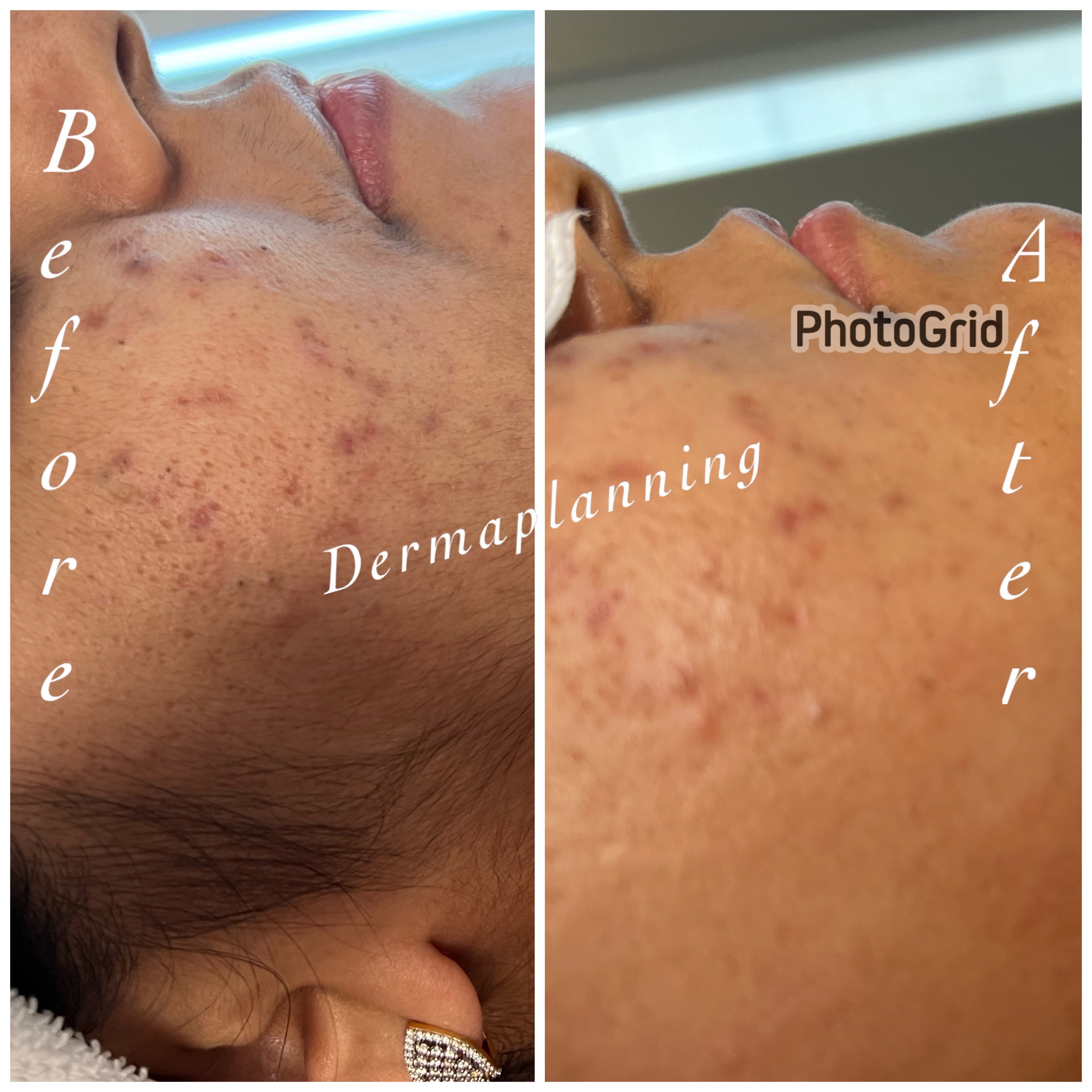 Dermaplaning before and after